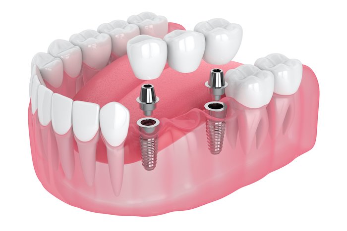 3d render of jaw with implants supported dental bridge