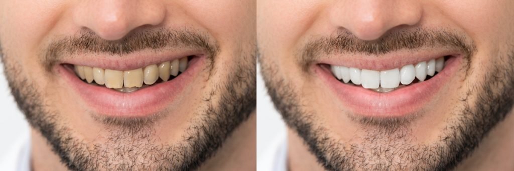Antes e Depois de um Branqueamento Dentário